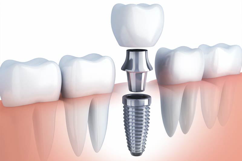 Implants Dentist in Cypress