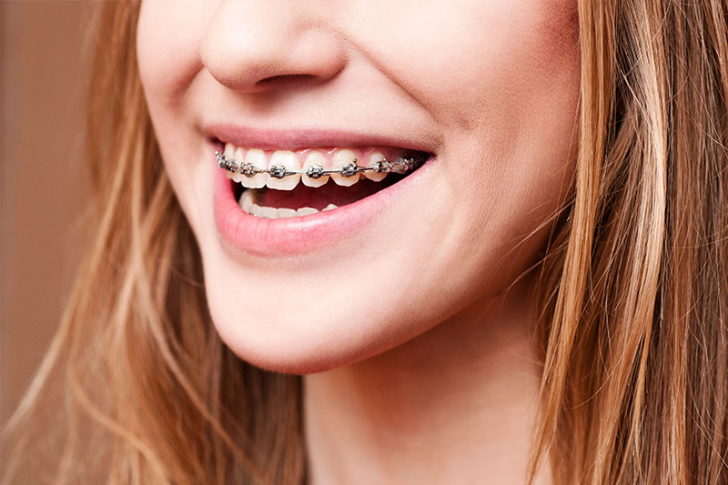 Orthodontics in Cypress