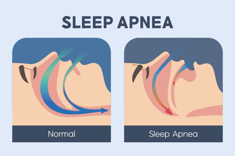 Sleep Apnea Treatment in Cypress, TX