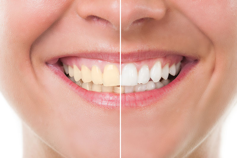 Teeth Whitening in Cypress